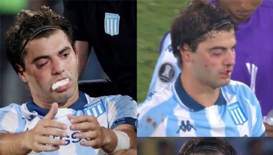 Marcos Rojo fracturó a Santi Sosa y así quedó el futbolista de Racing