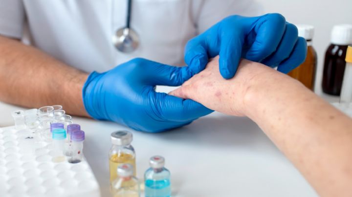 Alerta epidemiológica: cuántos casos de sarampión hay en Argentina