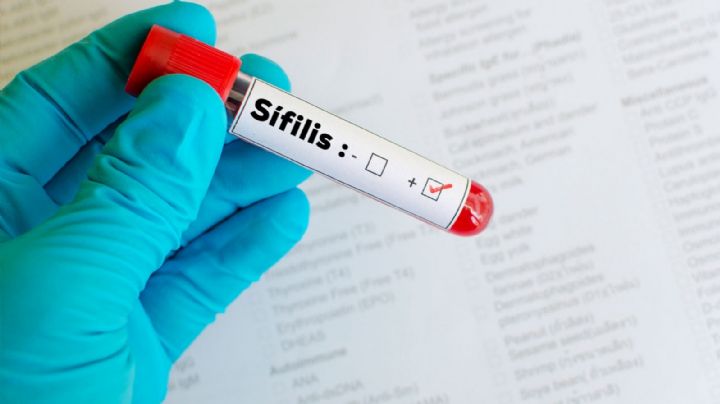 Aumentan los casos de sífilis en el mundo: qué pasa en Mendoza
