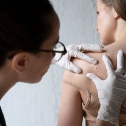 Cáncer de piel: la importancia del diagnóstico temprano