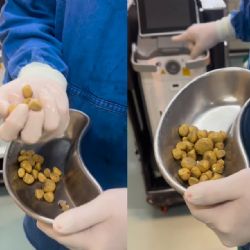 Bebía dos litros de gaseosa por día y le sacaron 35 piedras del riñón