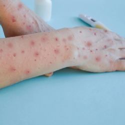 Confirmaron dos nuevos casos de viruela del mono en Córdoba