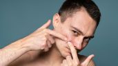 Foto ilustrativa de la nota titulada: Levadura, un aliado natural contra el acné