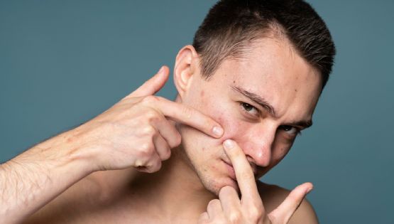 Levadura, un aliado natural contra el acné