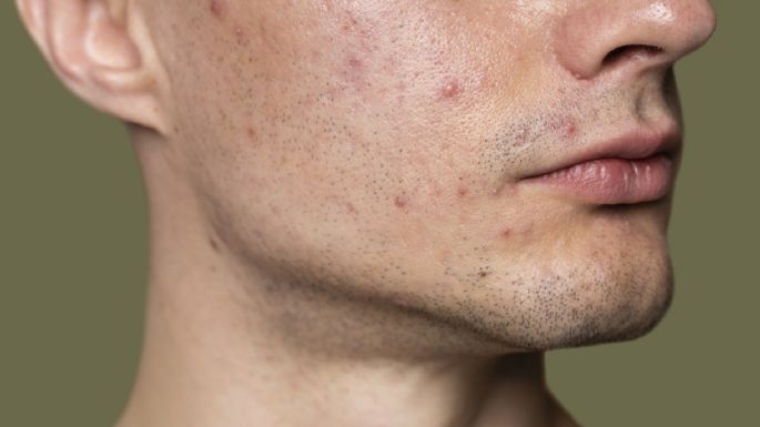 Levadura, un aliado natural contra el acné