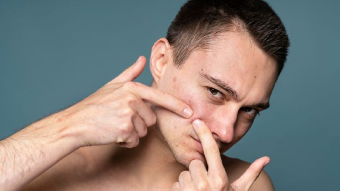 Levadura, un aliado natural contra el acné