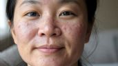 Foto ilustrativa de la nota titulada: Dormir bien, un desafío cotidiano para quienes viven con dermatitis atópica