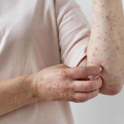 Alerta por un caso importado de sarampión en la Argentina 