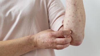 Alerta por un caso importado de sarampión en la Argentina 