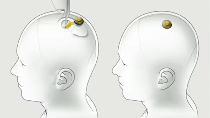 El chip de Neuralink que promete devolverle la visión a los ciegos