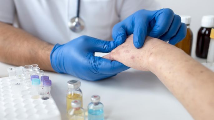 Preocupante: en 2025 hubo más de 46.000 casos de sífilis en Argentina